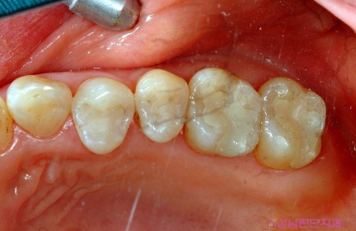 치아건강칼럼 - 충치치료 안하면 어떻게 될까?