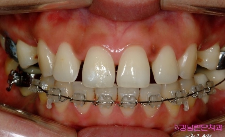 치아교정비 1.jpg