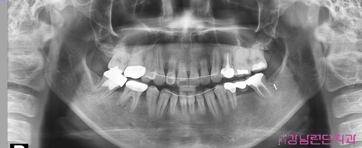 치아교정 통증 2.jpg