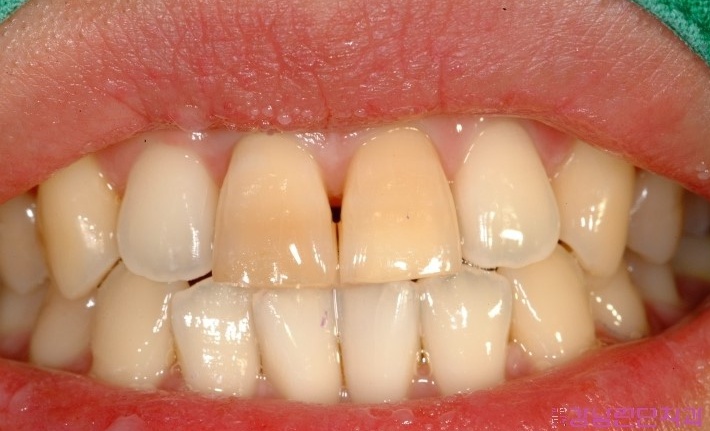 치아교정 통증 1.jpg