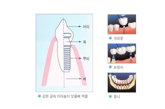 임플란트 1.jpg