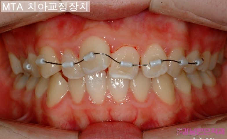 치아교정비 3.jpg