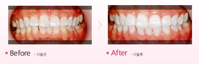 치아미백 효과 1.jpg