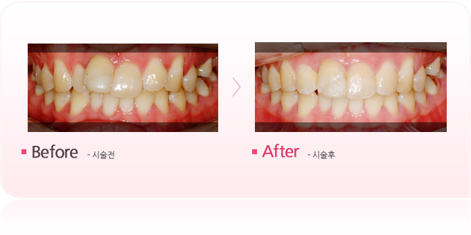 김봉주 - MTA브라켓1.jpg