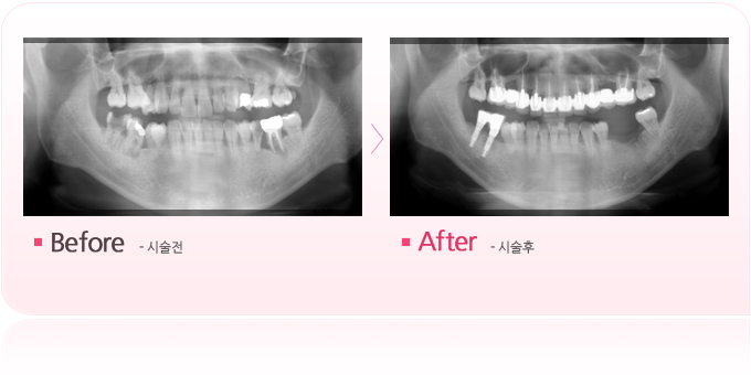풍치의해결.jpg
