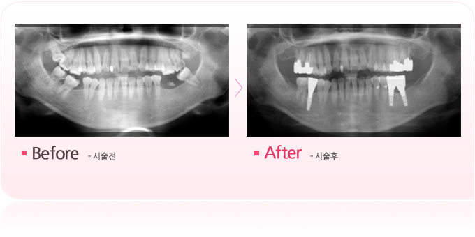 교정과임플란트.jpg