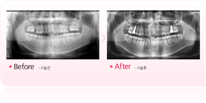 부분교정과 임플란트.jpg
