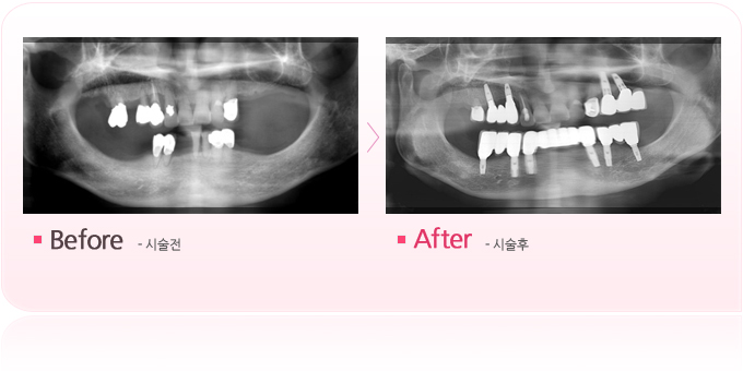 10년넘은틀니 임플란트교체.jpg
