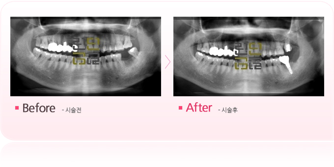 아스트라임플란트.jpg