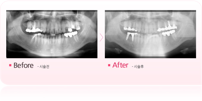 잇몸수술과임플란트.jpg