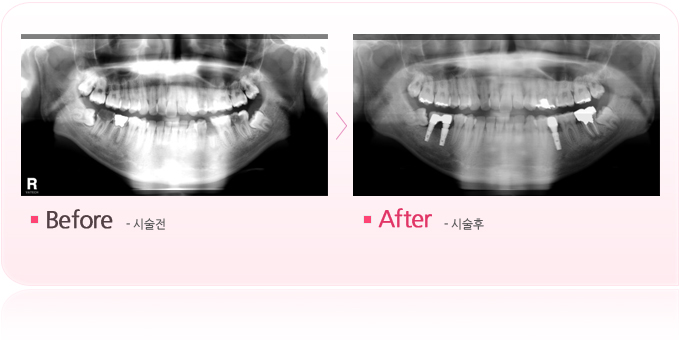 충치로인한발치후임플란트.jpg