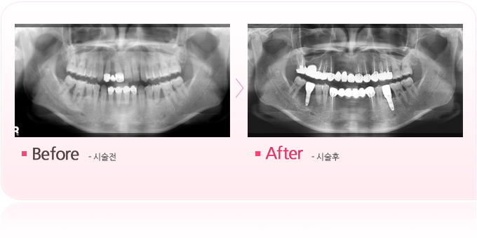 풍치와임플란트.jpg